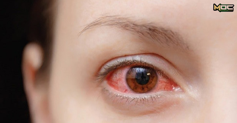 التهاب چشم