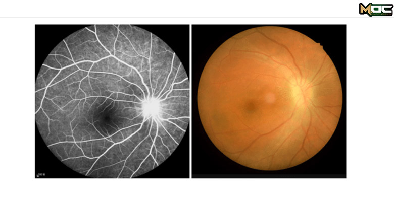 تغییر شکل چشم دراثر نوریت بینایی