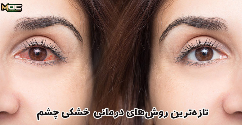 راه های درمانی خشکی چشم