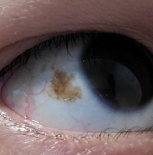 علت بروز لکه قهوه ‌ای روی چشم و درمان آن چیست؟