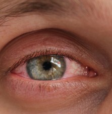 4 روش درمانی موثر برای بهبود خشکی چشم پس از عمل لیزیک چشم