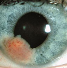 علائم هشدار دهنده سرطان چشم چیست