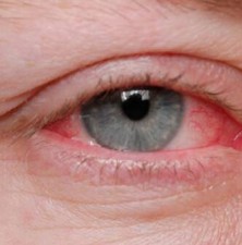  در فصل سرما مراقب ویروس عفونت چشمی باشید