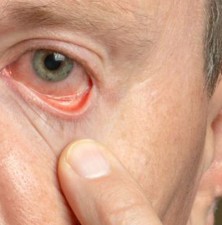 آنچه باید درباره علت و درمان قرمزی و خون آلود بودن چشم ها بدانید