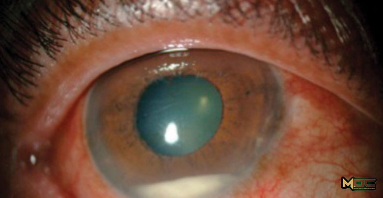 عفونت چشمی پس از جراحی